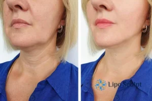 Double chin before and after Hi-Fu treatment 4 Book your double chin treatment Bradford today! We are here to help!