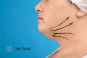 Double chin before and after Hi-Fu treatment 3 Boost your confidence with a Double chin treatment Bradford