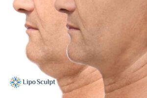 Double chin before and after Hi-Fu treatment 2 Double chin treatment Bradford from Lipo Sculpt - feel more confident today!