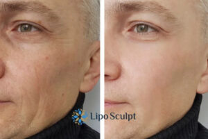 How to Fight Aging Symptoms 3 Fight Aging Symptoms Bradford With HIFU and Morpheus8 Today!