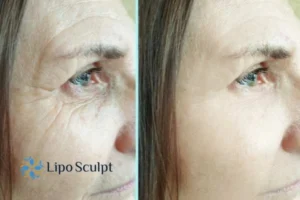 How to Fight Aging Symptoms 2 Do you want to Fight Aging Symptoms Bradford? Contact Lipo Sculpt today!