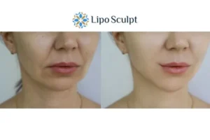 Explaining Total Skin Tightening Treatment And What It Can Do For You 2 Do you want to boost your self confidence? Give Morpheus8 Bradford a try today!