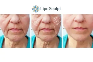 Explaining Total Skin Tightening Treatment And What It Can Do For You 3 Boost your confidence with Morpheus8 Bradford call our team today!