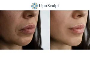 Explaining Total Skin Tightening Treatment And What It Can Do For You 4 Morpheus8 Bradford the best results - call our team today!