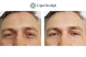 Explaining Total Skin Tightening Treatment And What It Can Do For You 6 Morpheus8 Bradford book in today to find out more!