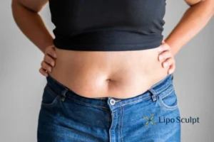 Bidding Farewell to Muffin Tops with Aqualyx Fat Injections 2 Do you wish you could reduce your muffin top Bradford With Aqualy fat dissolving injections you can!