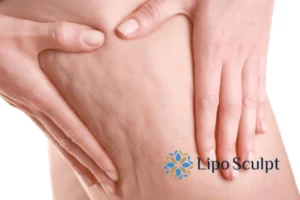 CoolSculpting for Legs: The Innovative Approach to Redefining Your Legs 5 Start your journey today book your coolsculpting treatment Bradford online today!
