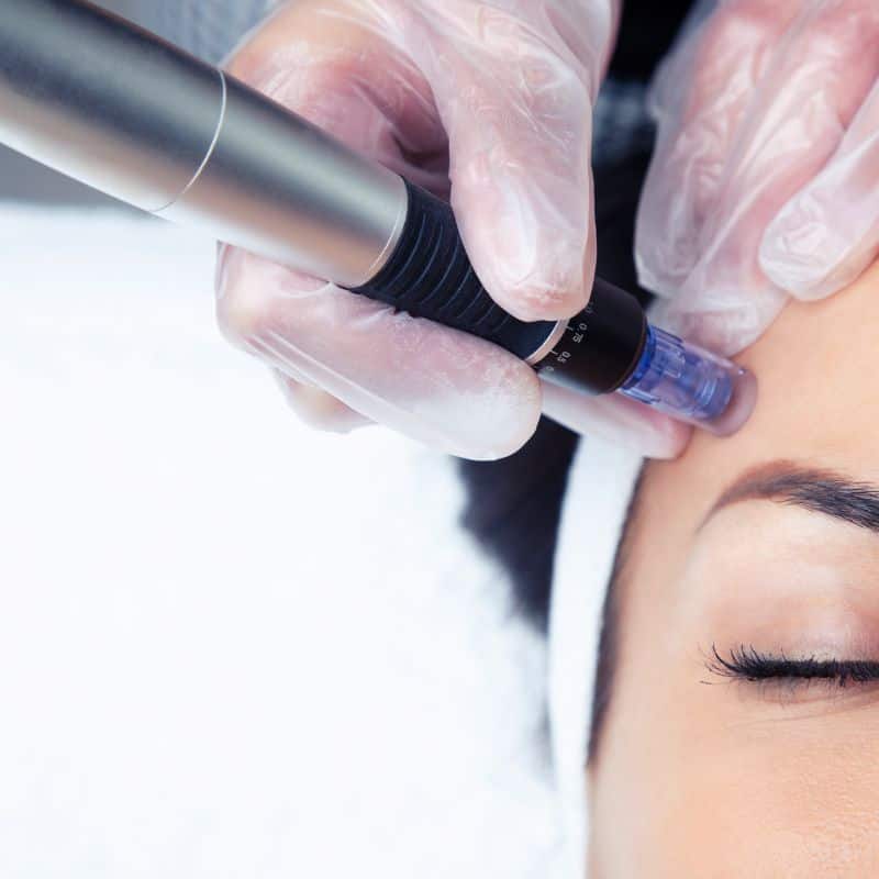 Morpheus8 treatment Bradford from Lipo Sculpt - Book in today!